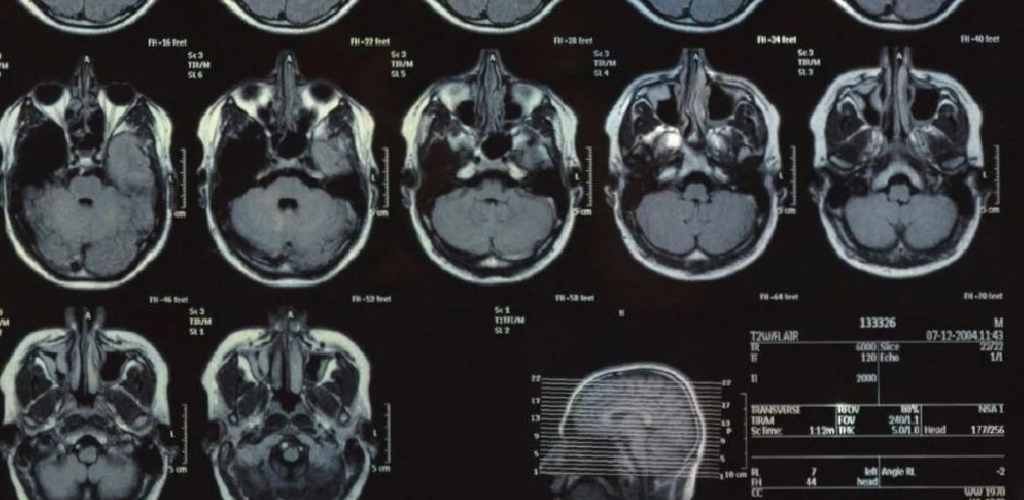 Brain Tumor Day