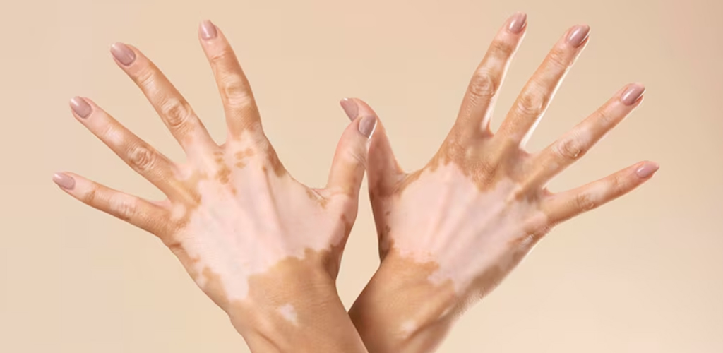 vitiligo_day